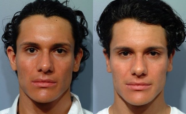 22-foto-antes-e-depois-de-otoplastia-masculina