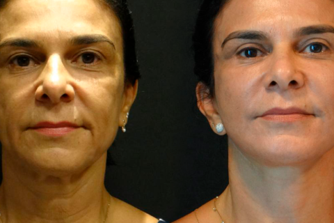 antes-e-depois-1